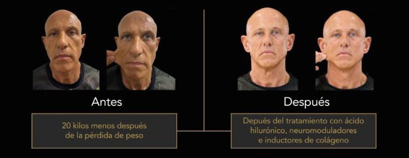 Antres Y Depues Aaclinic